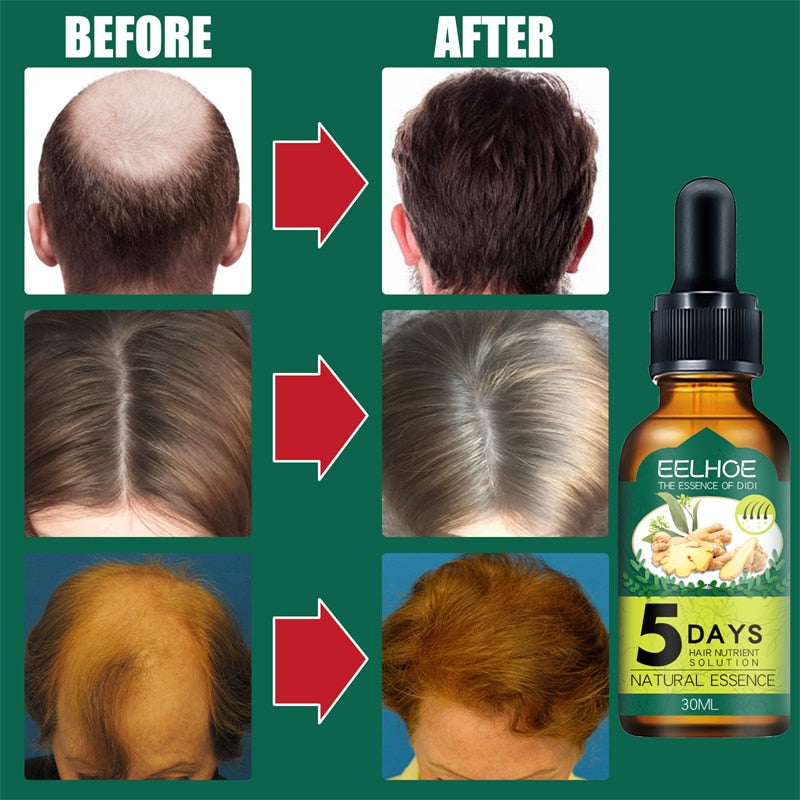 5 Days Ginger Hair Growth Products Natural Anti Hair Loss Prevent Baldness Treatment Fast Growing Nourish Dry Damaged Hair Care