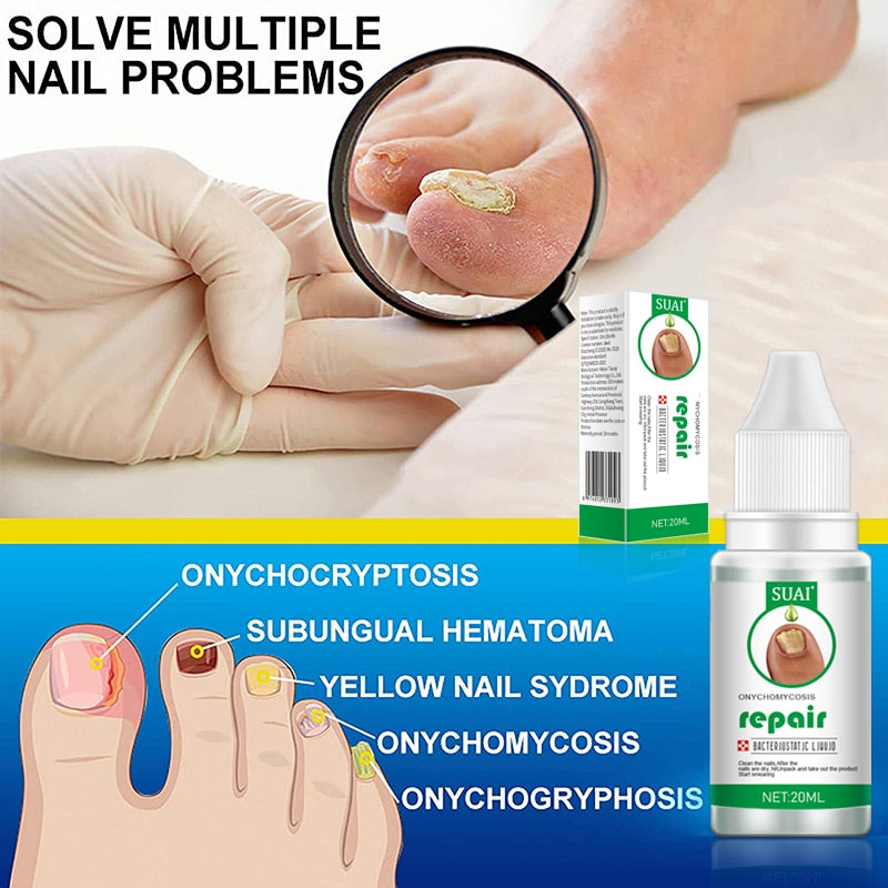 SUAI Nail Fungal Treatment Feet Care Essence Foot Repair Nail Fungus Removal Serum Gel Anti Infection Paronychia Onychomycosis